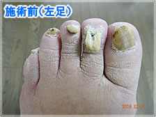 フットケア施術前(左足)
