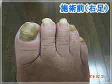 フットケア施術前(右足)