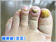 フットケア施術後(左足)