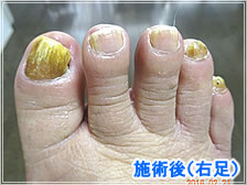 フットケア施術後(右足)