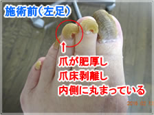 フットケア施術前(左足)