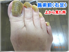 フットケア施術前(右足)