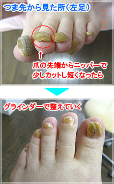 つま先から見た所(左足)爪の先端からニッパーで少しカットし短くなったらグラインダーで整えていく